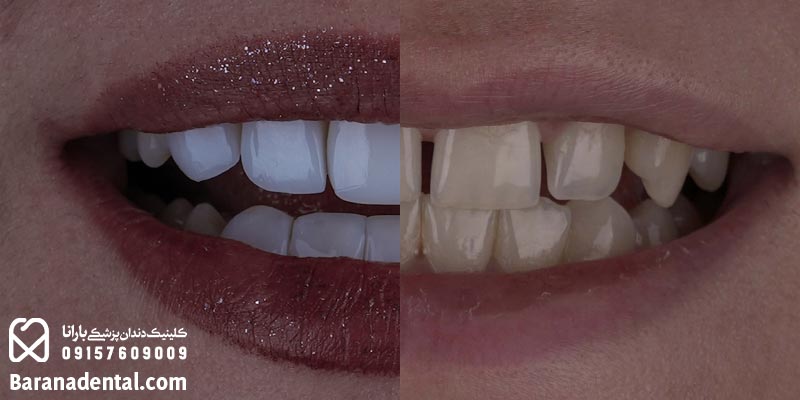 کامپوزیت دندان برای چه کسانی قابل اجراست؟