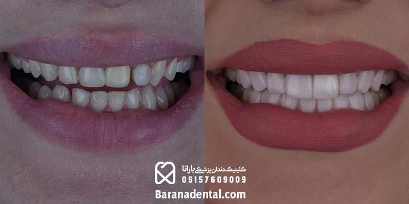 نمونه کامپوزیت دندان در مشهد