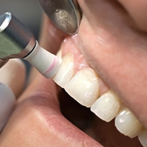جرمگیری دندان ها قبل از نصب کامپوزیت در صورت نیاز
