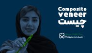 کاربرد و مزایای ونیر کامپوزیت دندان در مشهد