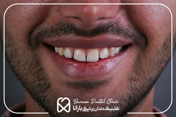 اصلاح بد رنگی و بد فرمی دندان ها با کامپوزیت