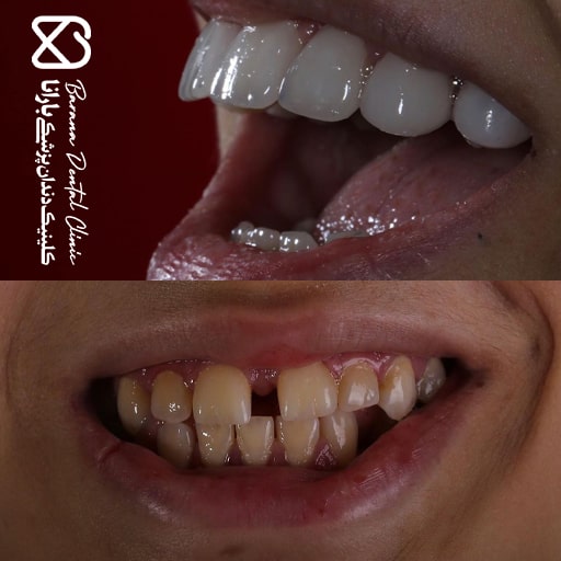 اصلاح فاصله بین دندان ها با لمینت