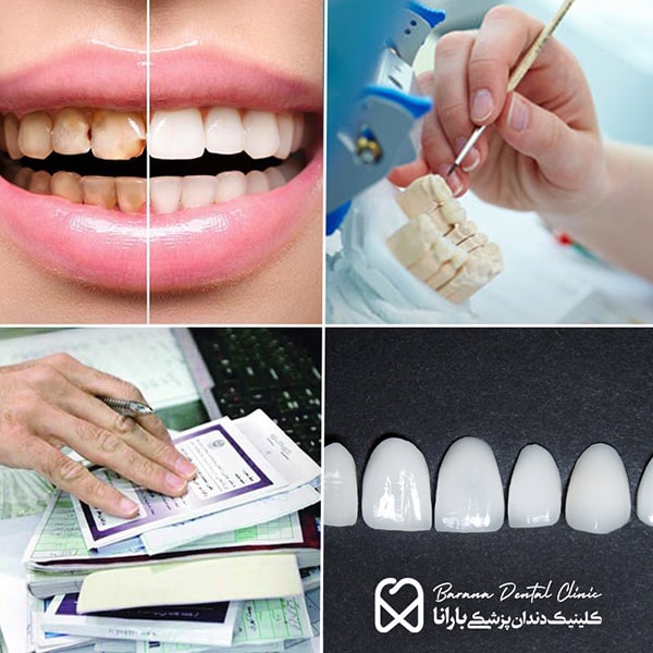 عوامل مؤثر بر قیمت لمینت دندان مشهد
