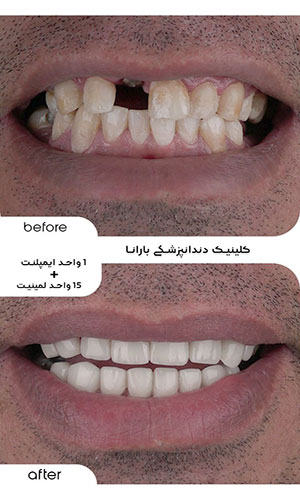 نمونه کار قبل و بعد از لمینت دندان در مشهد