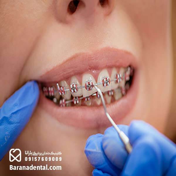 مرحله نصب بریس ها روی دندان