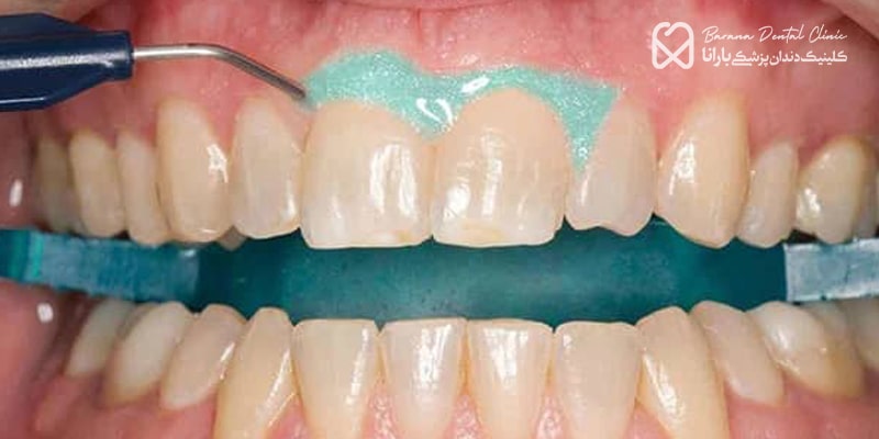 سفید کردن دندان ها توسط دندانپزشک
