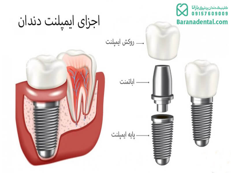 ساختار تشکیل دهنده ایمپلنت دندان