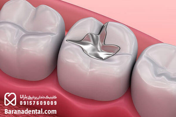 پر کردن دندان با مواد سیاه یا نقره ای در مشهد
