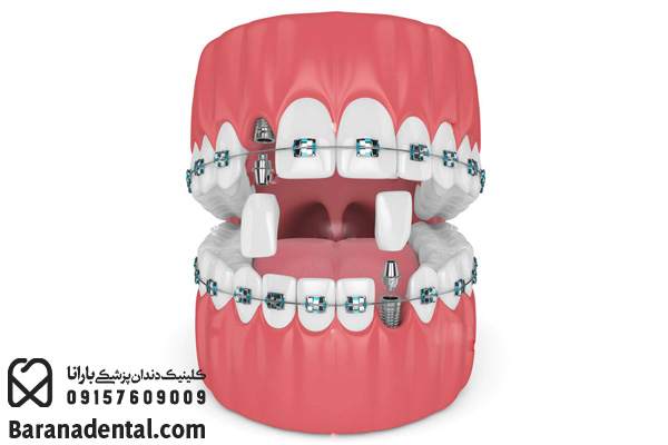 استفاده همزمان از درمان‌های ایمپلنت و ارتودنسی دندان