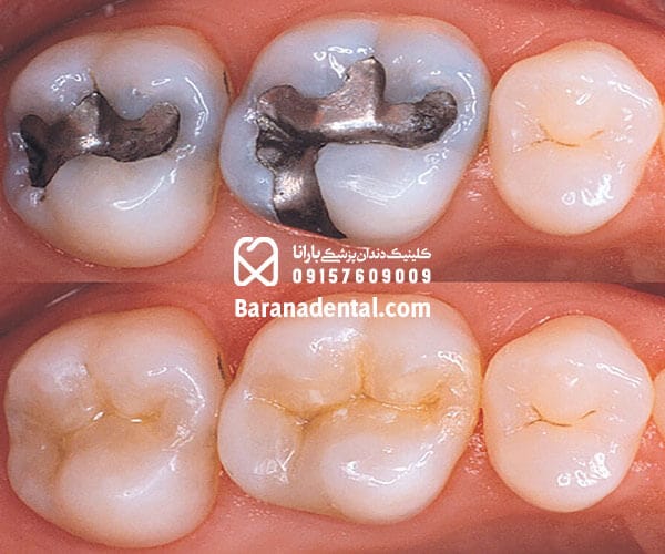 قبل و بعد ترمیم دندان با آمالگام نقره‌ای