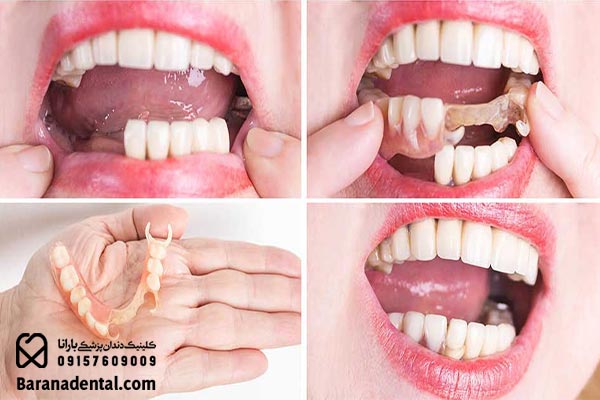 بریج دندان چه مزایایی دارد؟