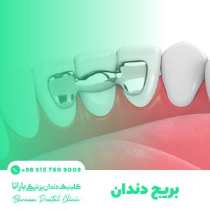انواع بریج دندان در مشهد