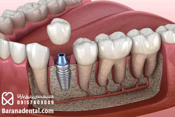 کاشت دندان با روش ایمپلنت