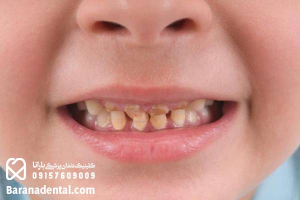 پوسیدگی دندان های شیری کودکان