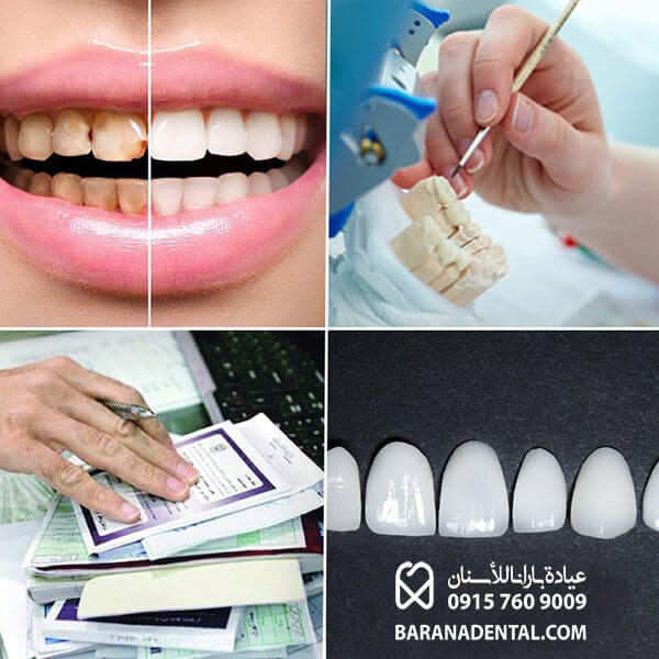 عوامل مؤثر على سعر ليمينت الأسنان