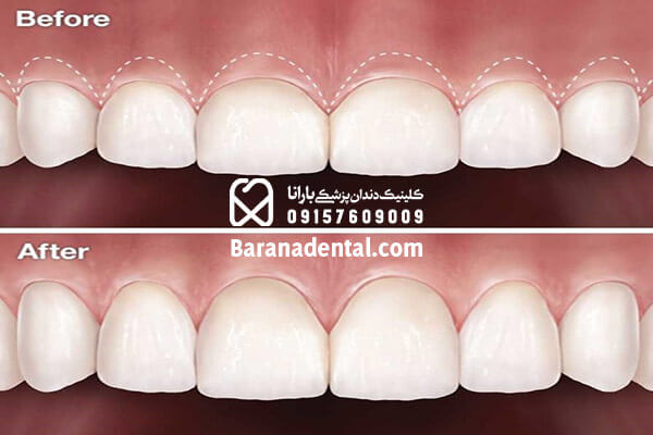 افزایش طول تاج دندان یکی از شیوه های جراحی لثه