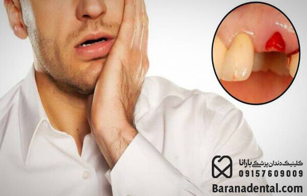 درد بعد از کشیدن دندان نیش