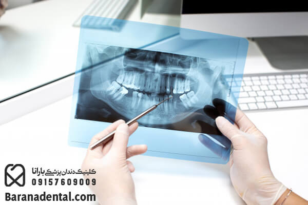 عکس رادیولوژی قبل از کشیدن دندان