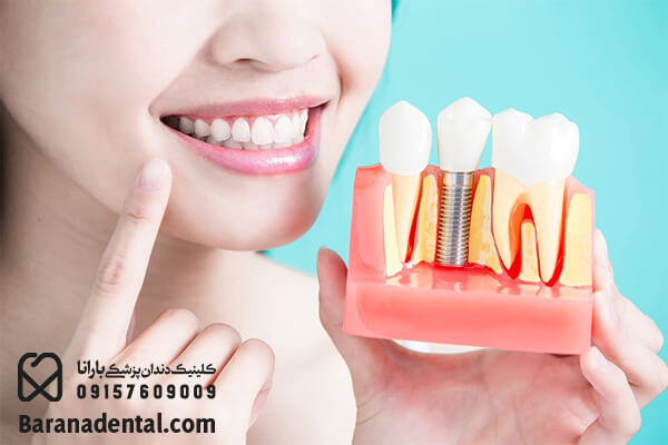 مزایای انجام ایمپلنت دندان به صورت فوری