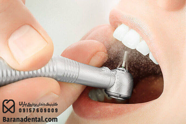 در روش پالیش تک مرحله ای نهایت سایش روی دندان انجام میشود