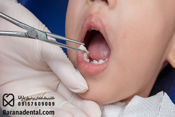 کشیدن دندان شیری کودکان