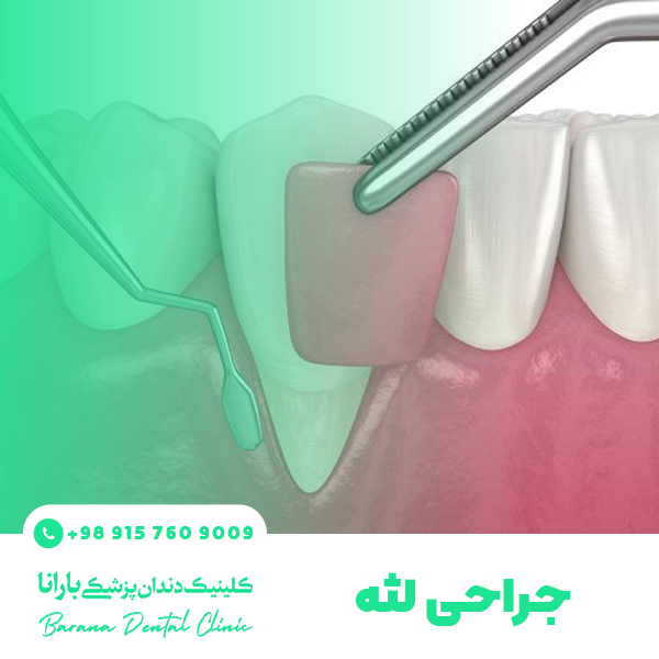 جراحی لثه برای حفظ دندان ها ضروری است