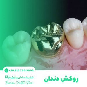 روش کاشت دندان بریج