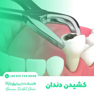 کشیدن دندان در مشهد با قیمت مناسب
