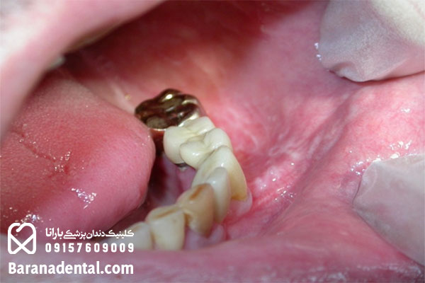 حساسیت دندان به فلز 