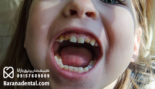 علت تغییر رنگ دندان کودکان