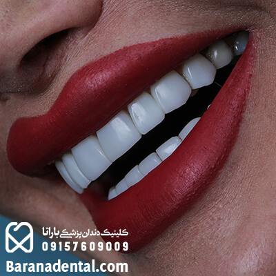 نمونه کار کامپوزیت دندان کلینیک بارانا