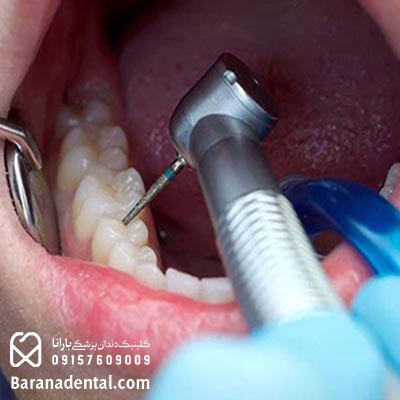 ترمیم دندان در دندانپزشکی قسطی مشهد 