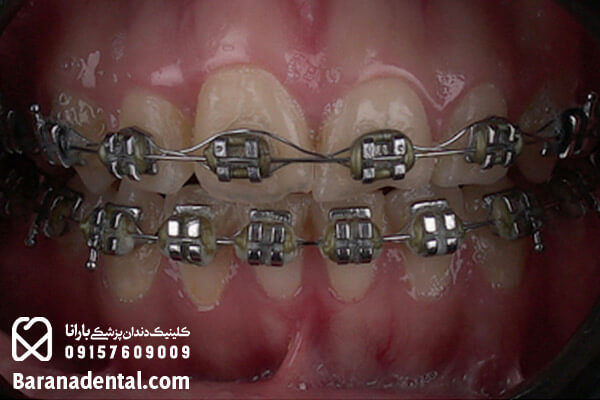 حین درمان ارتودنسی دندان