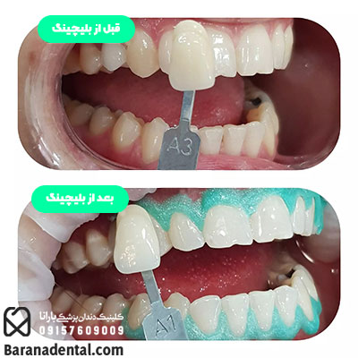 تصویر قبل و بعد از انجام بلچینگ دندان