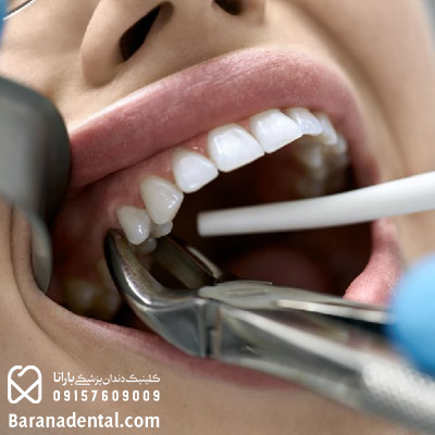 کشیدن دندان در یکی از بهترین کلینیک های دندانپزشکی در مشهد