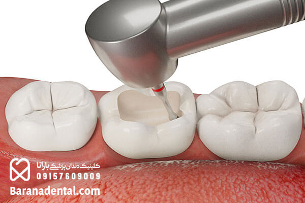 استفاده از مواد کامپوزیت یکی از درمان های مدرن در دندانپزشکی بدون درد است