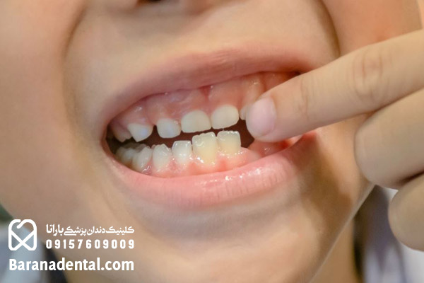دندان‌های دائمی چگونه‌اند؟