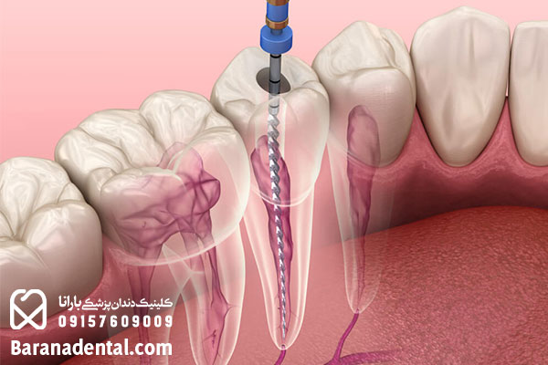 تفاوت عصب کشی سنتی و مدرن 