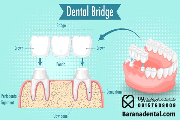 انواع روش های کاشت دندان 