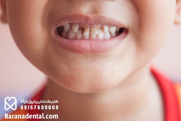 نشانه های خراب شدن دندان کودک