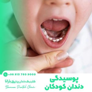 علت پوسیدگی دندان کودکان