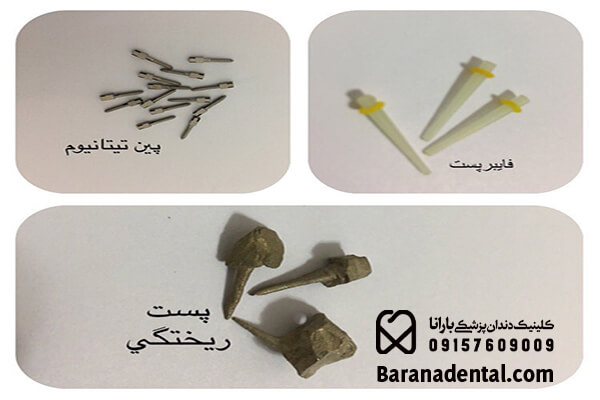 انواع پست دندان