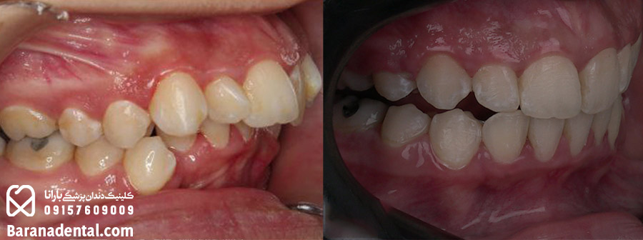 دندان ارتودنسی شده قبل و بعد