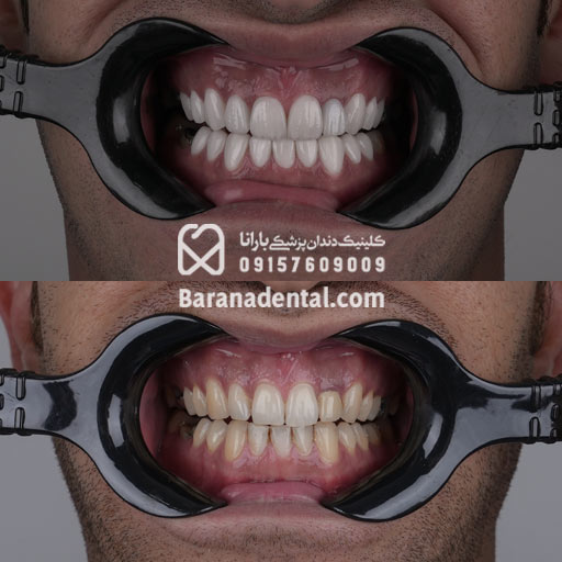 عکس قبل و بعد لمینت دندان های زرد