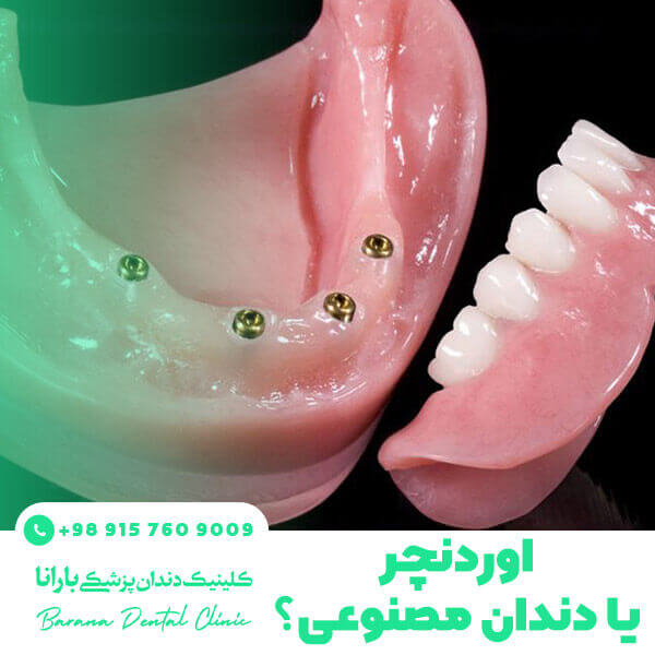 پروتز دندان بر پایه ایمپلنت