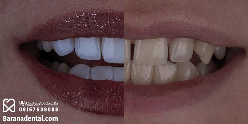 تغییر چشمگیر دندانها بعد از انجام کامپوزیت