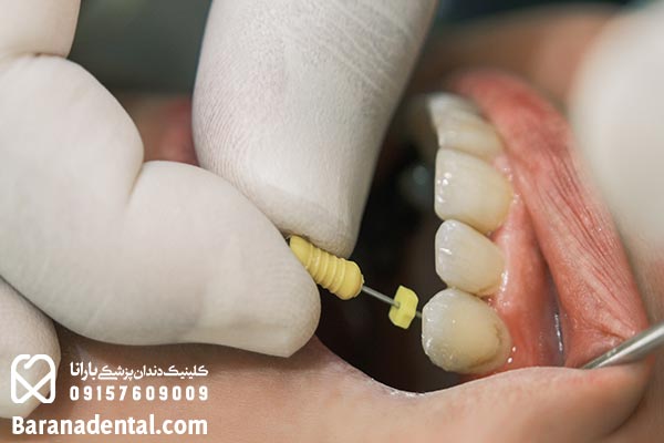 ترمیم ریشه دندان عفونی بعد از عصب کشی