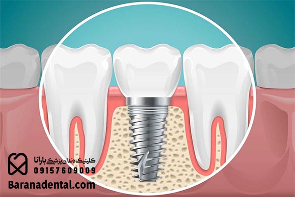 لق شدن ایمپلنت دندان چه علائمی دارد