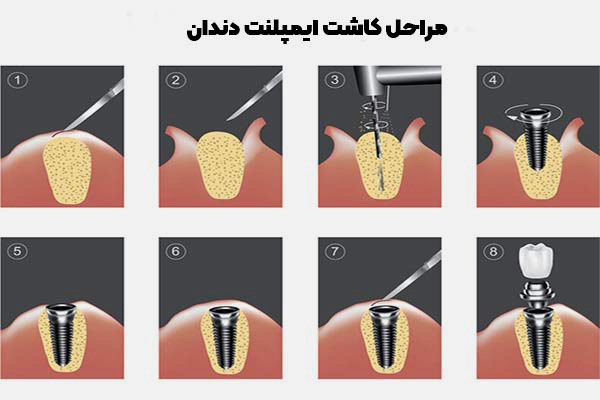 کاشت ایمپلنت دندان چه مراحلی دارد