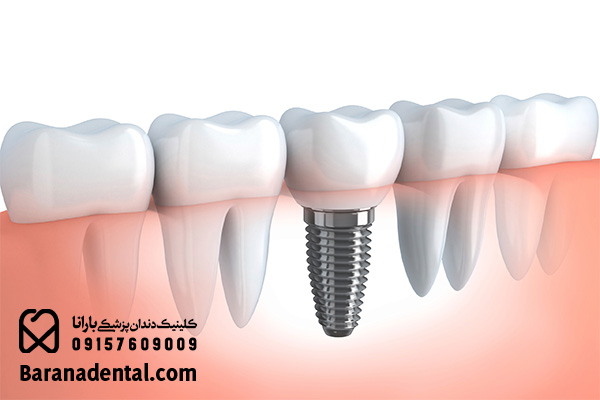کاربرد پایه ایمپلنت دندان